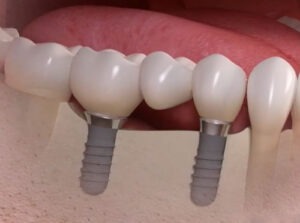 keliu-dantu-implantavimo-kaina-altadenta